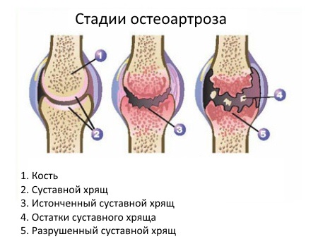 artrosis-scheme